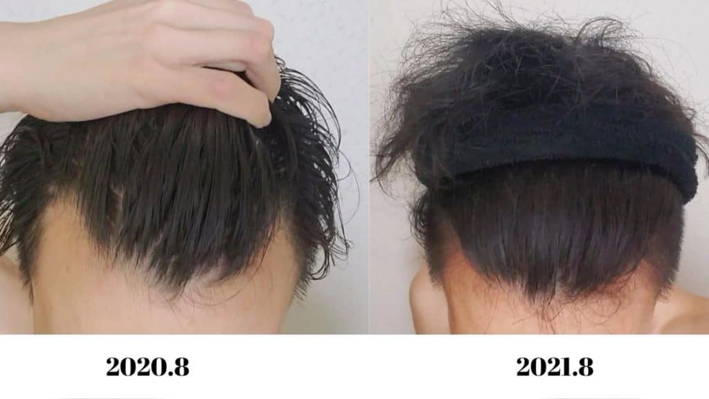 , 自慰行為; ハゲる原因はたくさんあります。