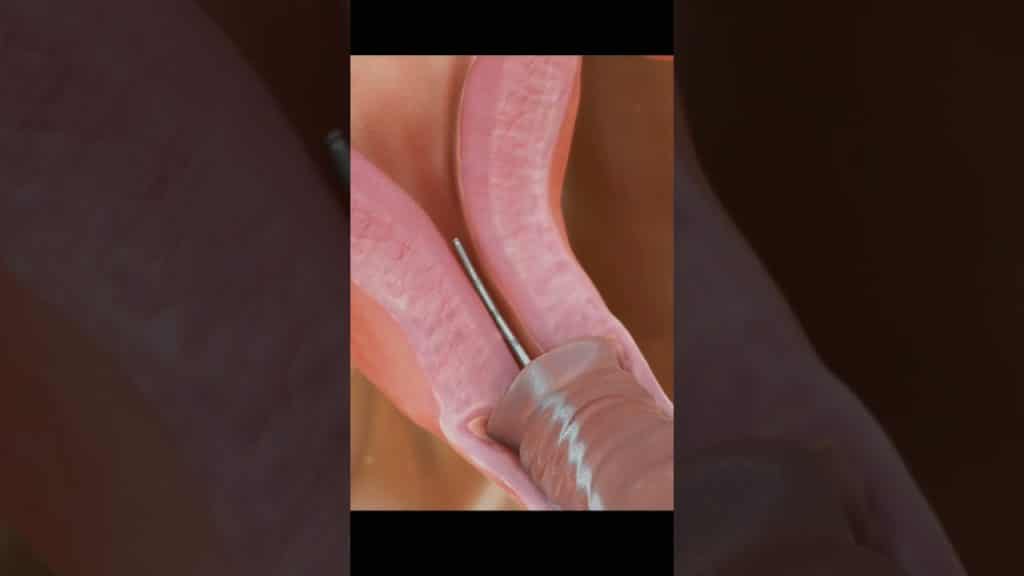 , Youtube (controlled male chastity): Insertion of IUD (Intrauterine Device) to Prevent Pregnancy | Birth Control #4k #animation #asmr|controlled male chastity,Insertion of IUD (Intrauterine Device) to Prevent Pregnancy | Birth Control #4k #animation #asmr sur Youtube